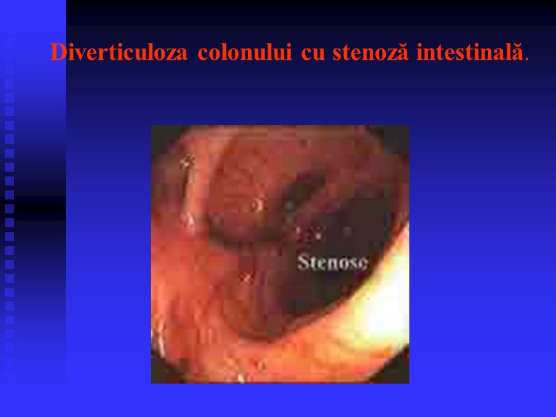 Diverticuloza colonului cu stenoză intestinală.